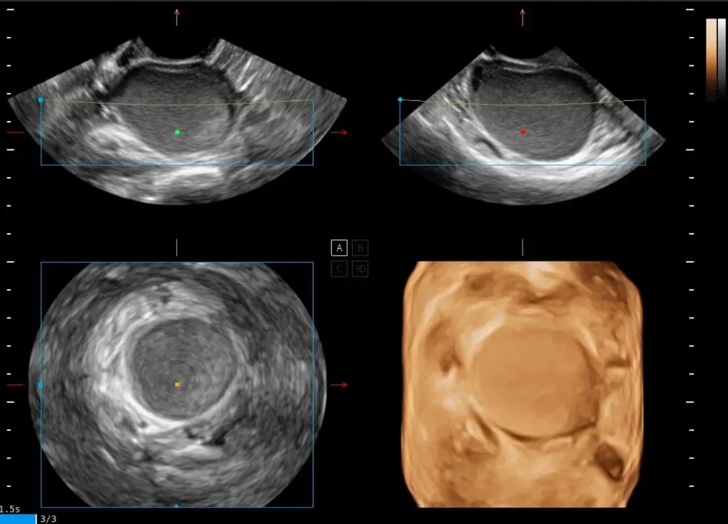 Vistas transversales y volumen 3D de lesión endometriósica